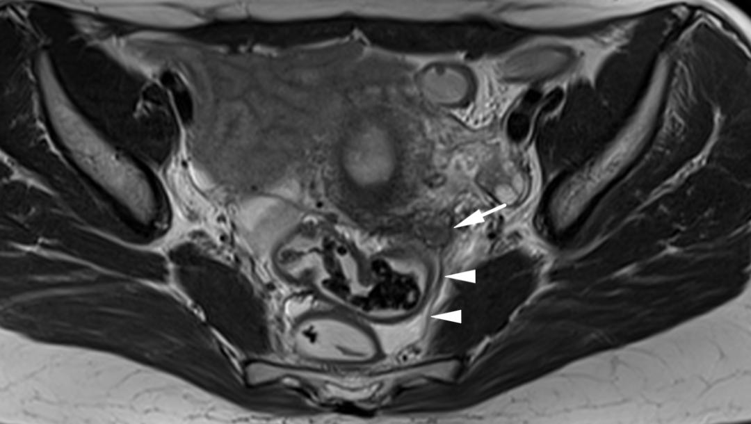 MRI如何评估子宫内膜异位症？这10个病例会帮助您