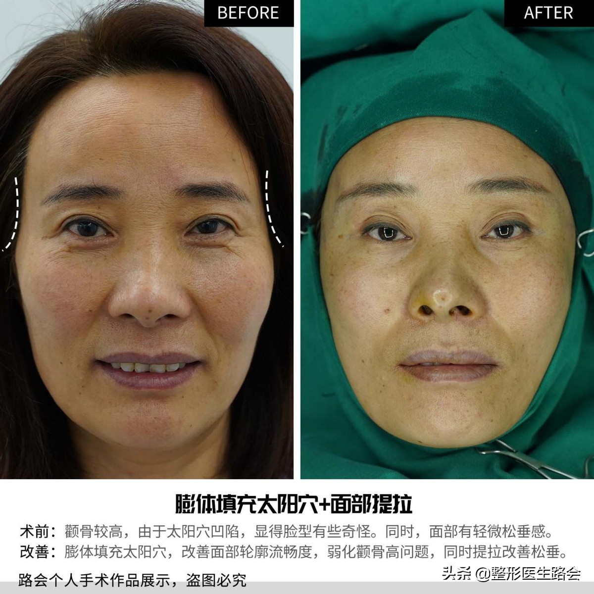 太阳穴填充的缺点跟后遗症,太阳穴填充会不会有后遗症