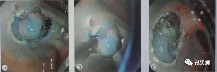 esd内镜下粘膜剥离几天可愈合,内镜下粘膜剥离术属于esd还是emr