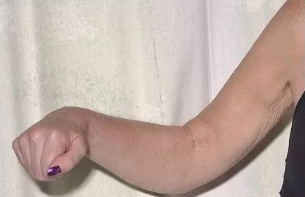 脑卒中后肌肉痉挛原因分析,脑卒中后肢体痉挛的临床研究