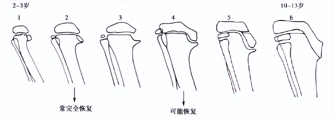 小腿变弯曲是缺钙了吗,小腿变弯处理方法