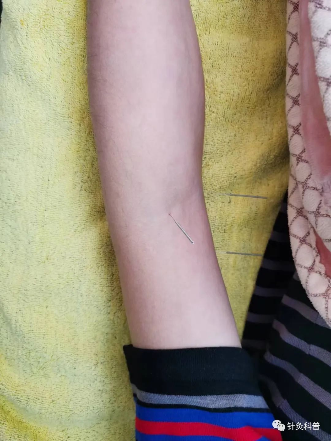 针灸治疗偏头痛的经方,针灸后偏头痛是怎么回事