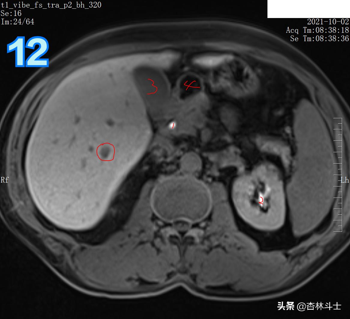 肝癌8公分肿瘤能活多久,肝癌细胞最大长多大
