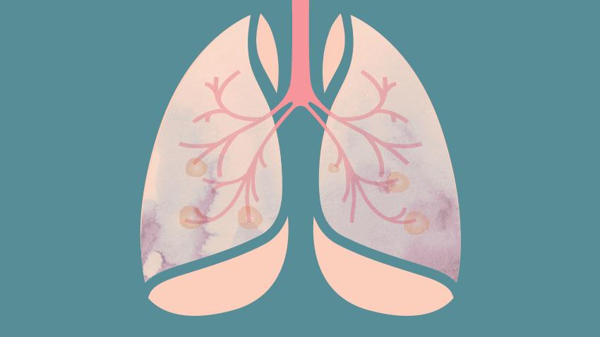 肺结节多大需警惕癌症,发现肺结节怎么知道是结节还是癌