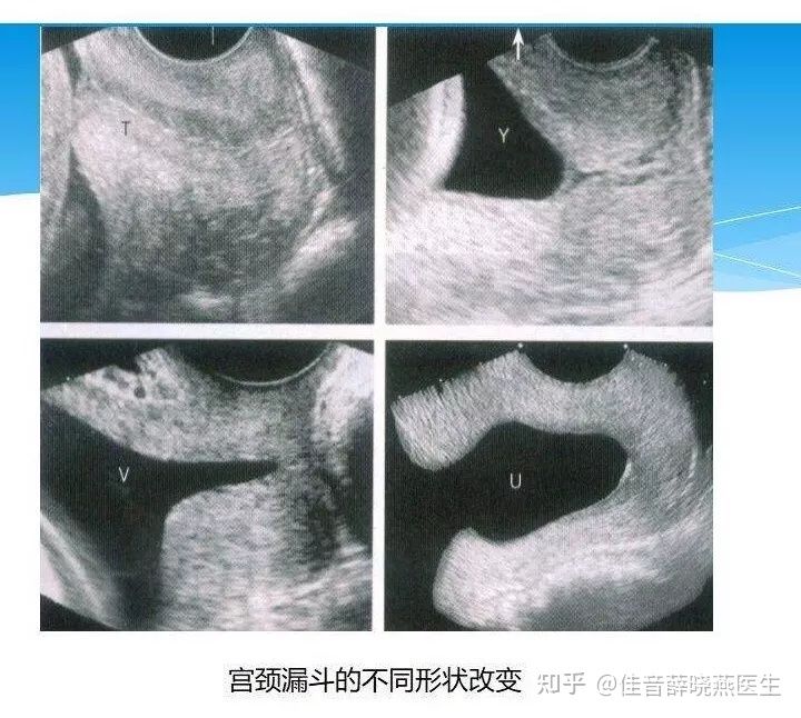 会从正常宫颈一下子变成宫颈癌吗,怎么发现自己有宫颈
