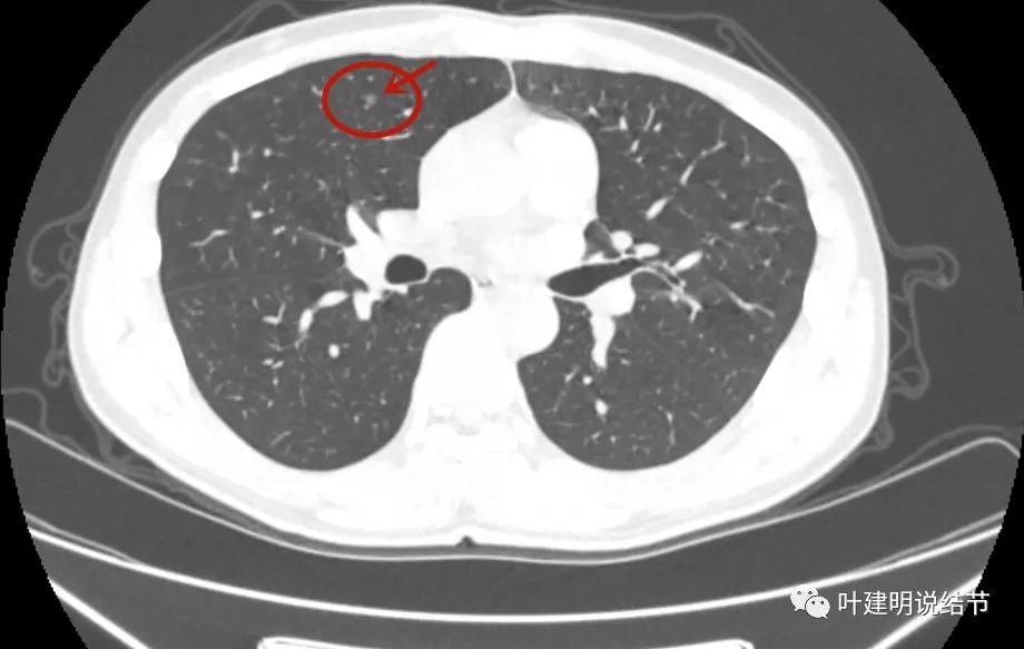 这样的多发病灶给试验性抗结核治疗?消失的结节是药的功劳吗?