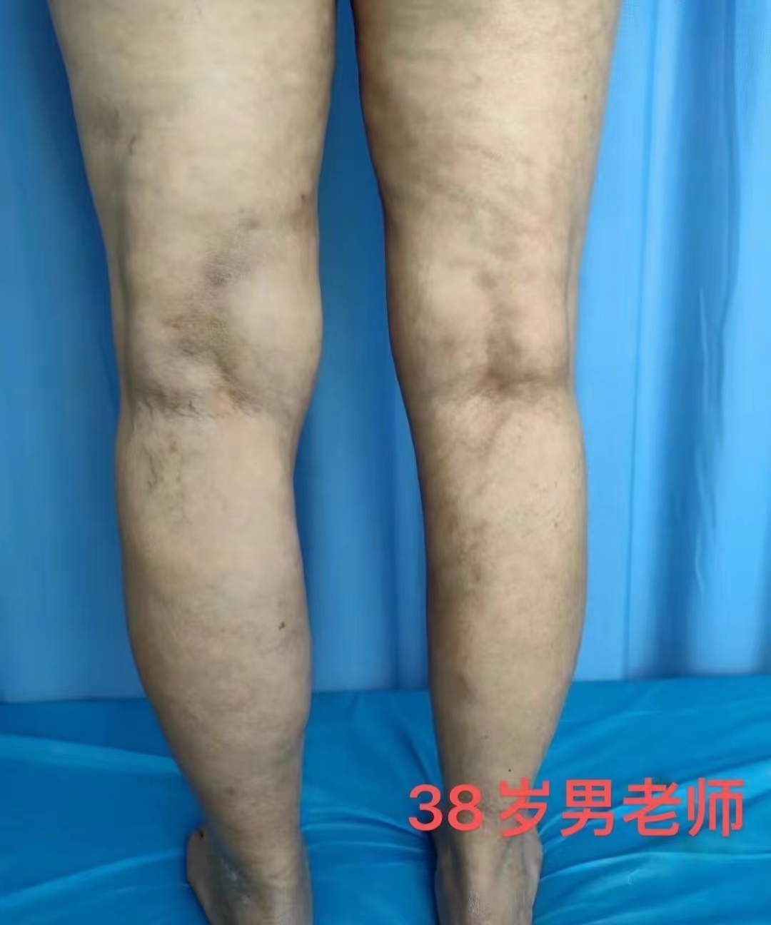 静脉曲张是什么原因怎样治疗最好,静脉曲张医生实例视频