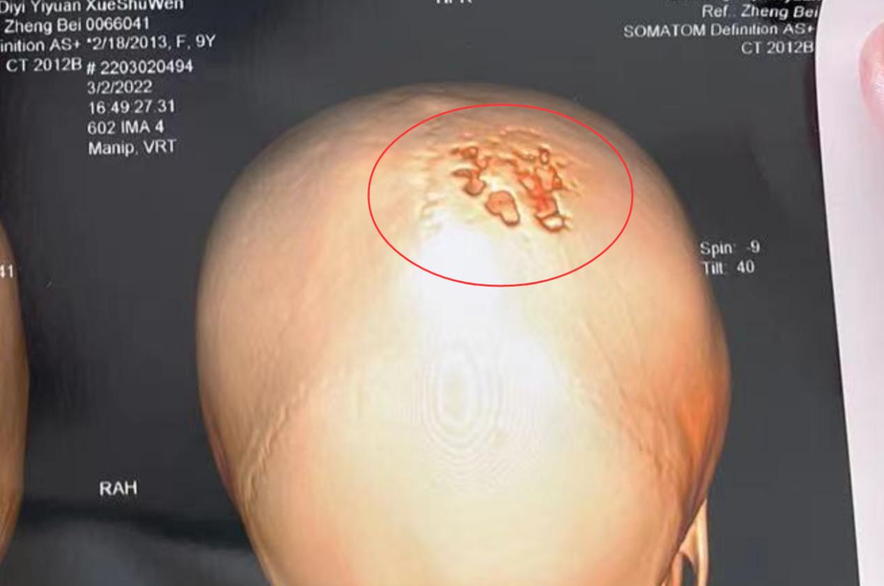 六岁女孩患脑瘤不幸离世,六岁女孩突发脑瘤