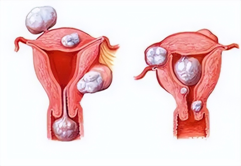 全国肿瘤防治宣传周原发性骨肿瘤,妇科肿瘤防控指南