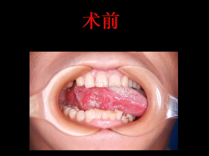 舌头一侧溃疡咽喉癌,舌头溃疡严重会是癌吗