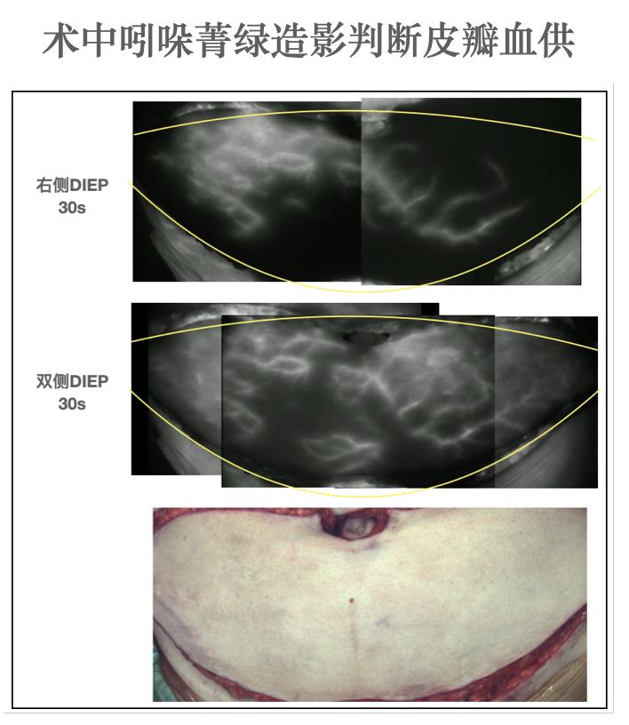 乳腺癌一期假体再造术,乳腺重建与乳房再造