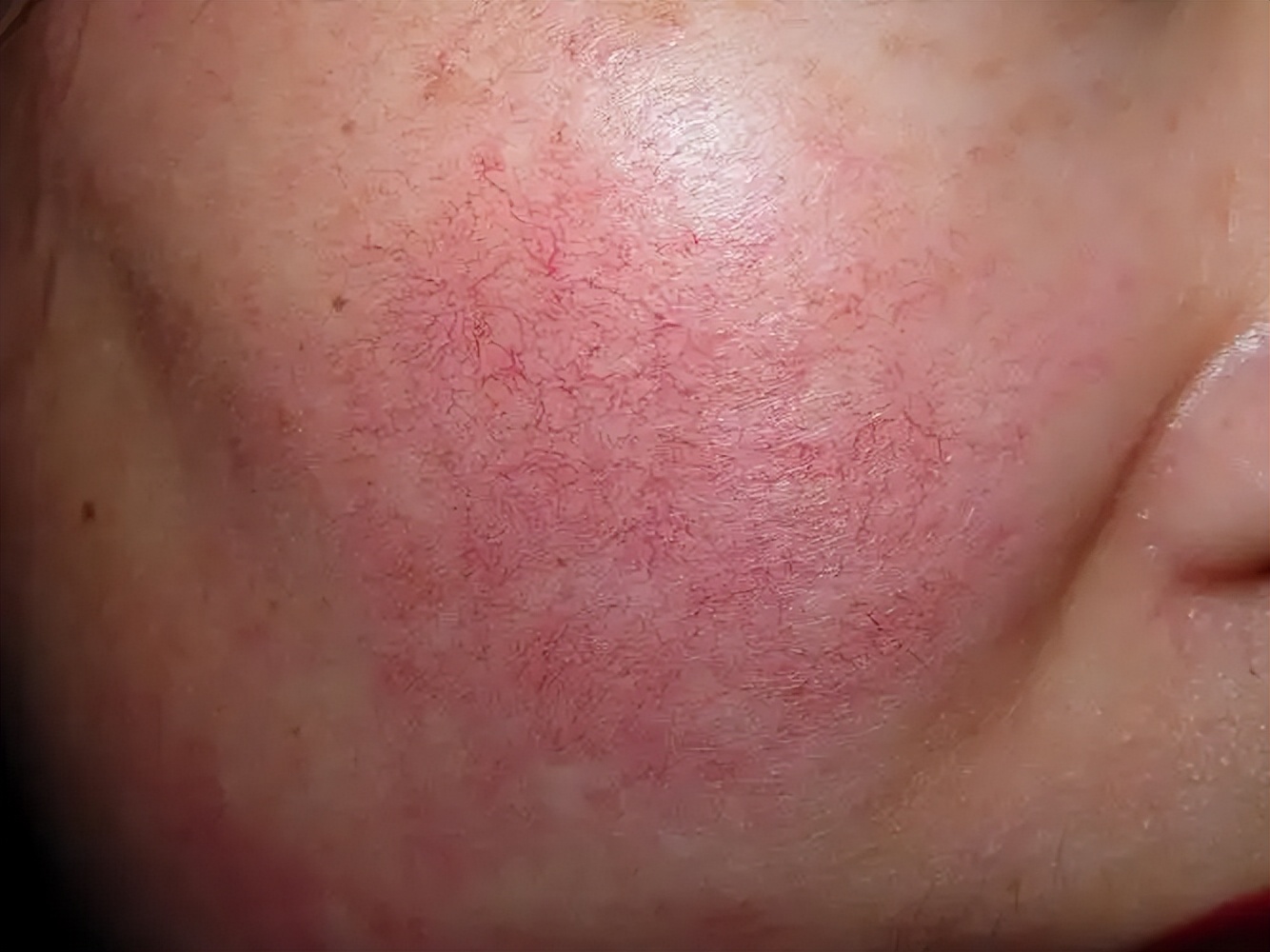 脸上突然出现*血丝红**？深扒*血丝红**形成的四大因素