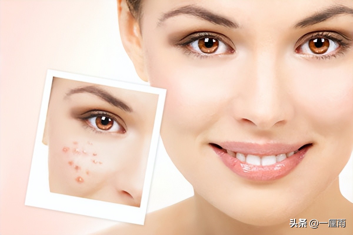 脸上起痘祛痘印的最佳方法,脸上痘痘痘印很严重如何快速祛痘
