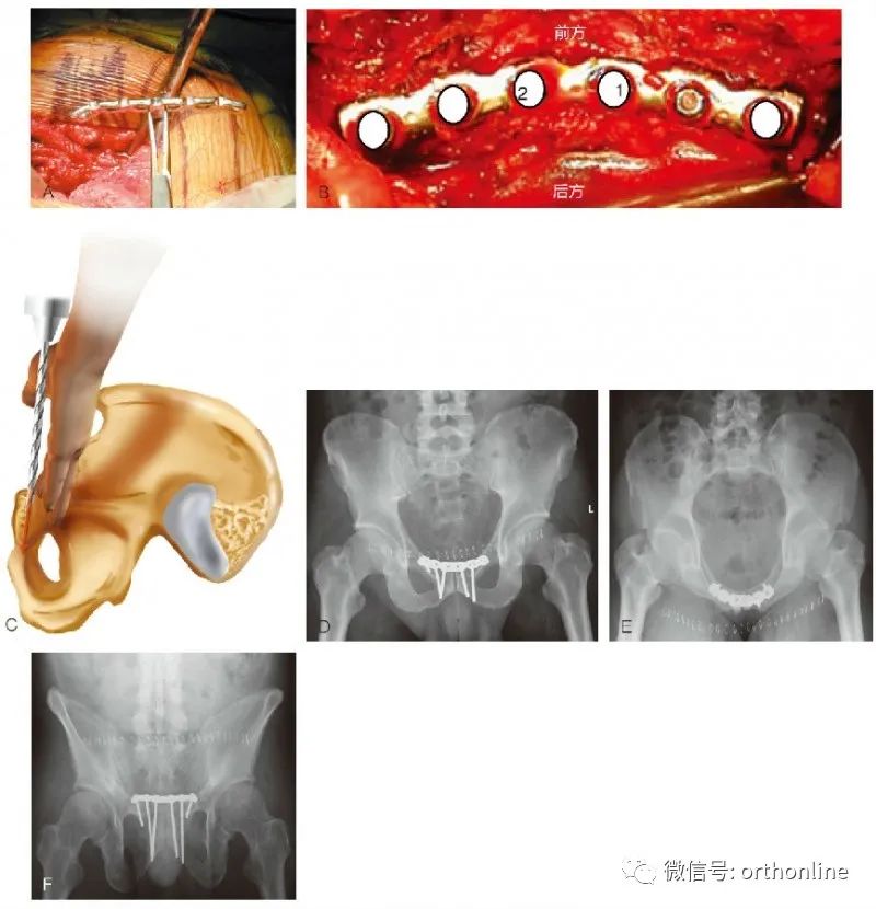 耻骨联合切开复位内固定临床操作与注意事项