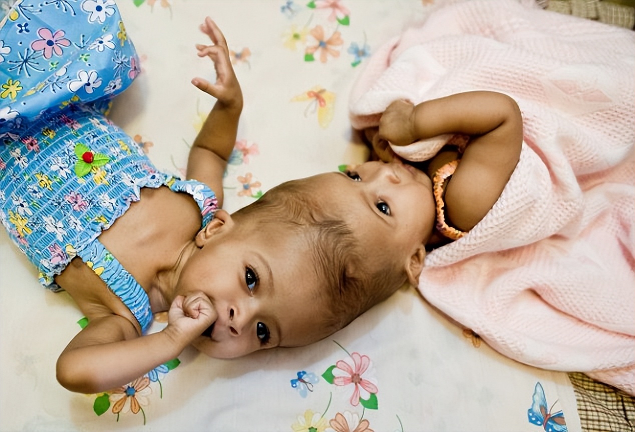 巴西连体双胞胎成功分离后续,巴西头部连体婴儿分离后续