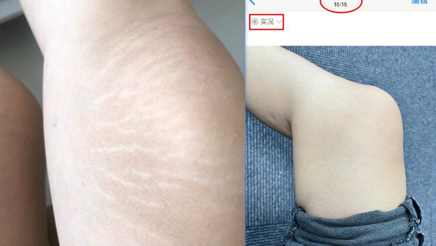 如何淡化腿上肥胖纹小窍门,腿上有肥胖纹怎么遮瑕