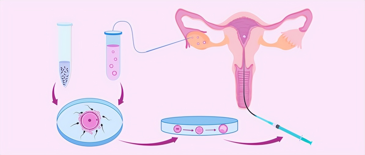 有关试管婴儿的知识,我的试管日记
