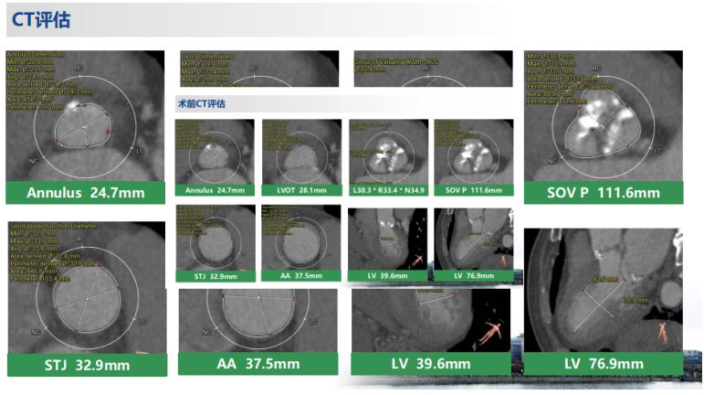 河南大学淮河医院顺利为一例二叶式主动脉瓣重度狭窄伴重度钙化的病人实施了经导管主动脉瓣置换术