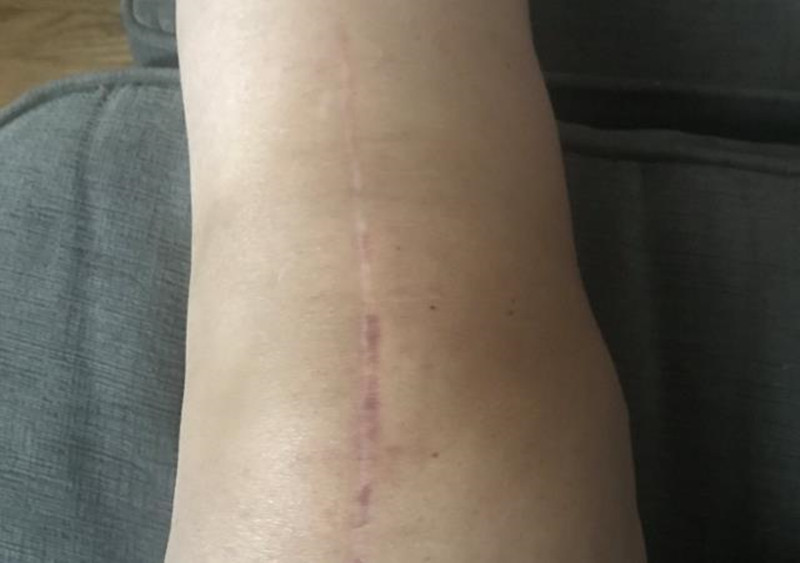 换了膝盖多长时间就不痛了,换了膝盖怎么康复