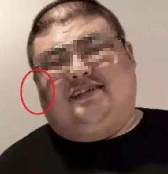 胖子脸黑斑,胖子脖子有黑斑是怎么回事