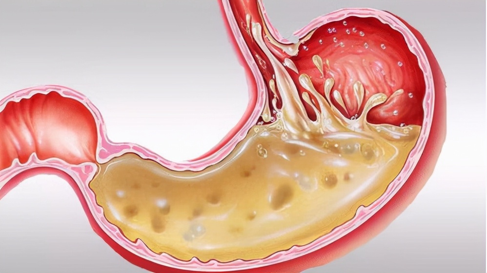 受凉引起的胃酸如何快速缓解,突然胃酸倒流烧嗓子怎么快速缓解