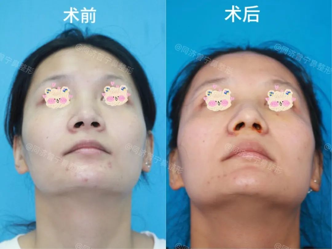 鼻头肉多怎么改善,鼻头大瘦下来鼻头会不会变小