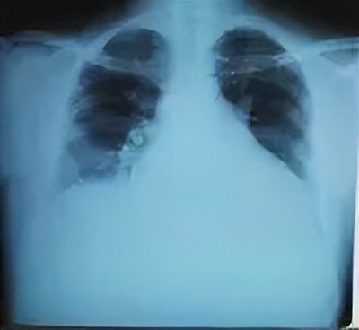 扩张型心肌病之科普小问答四,扩张型心肌病之科普四