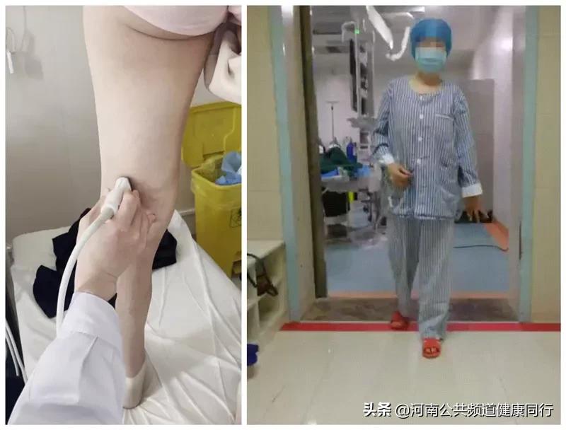 利用周末或者假期完成一个手术？河南省直三院血管外科推出“节假日无休，微创无瘢痕治疗下肢静脉曲张”