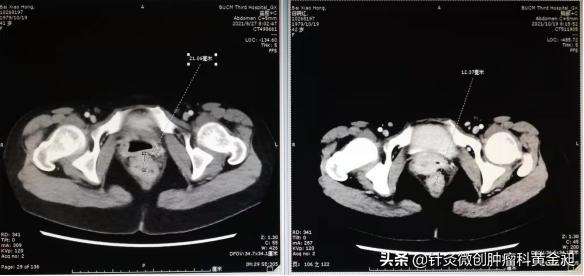 直肠癌晚期化疗靶向奇迹痊愈,直肠癌化疗两次痊愈