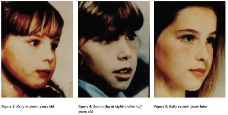 腺样体肥大孩子变丑,腺样体肥大大概几岁开始面貌变丑