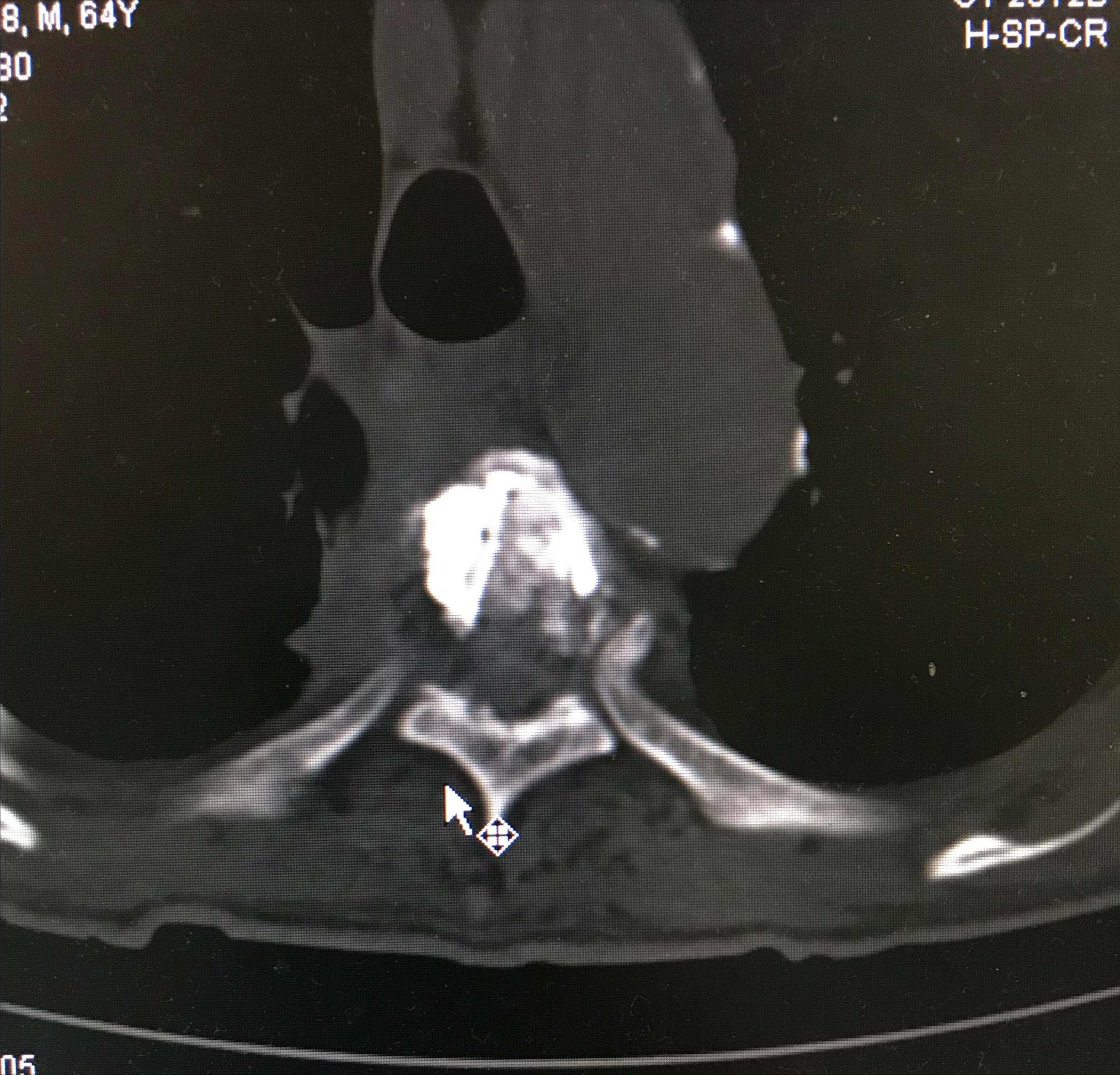 胸椎压缩性骨折微创手术利弊,胸椎压缩性骨折保守治疗20例