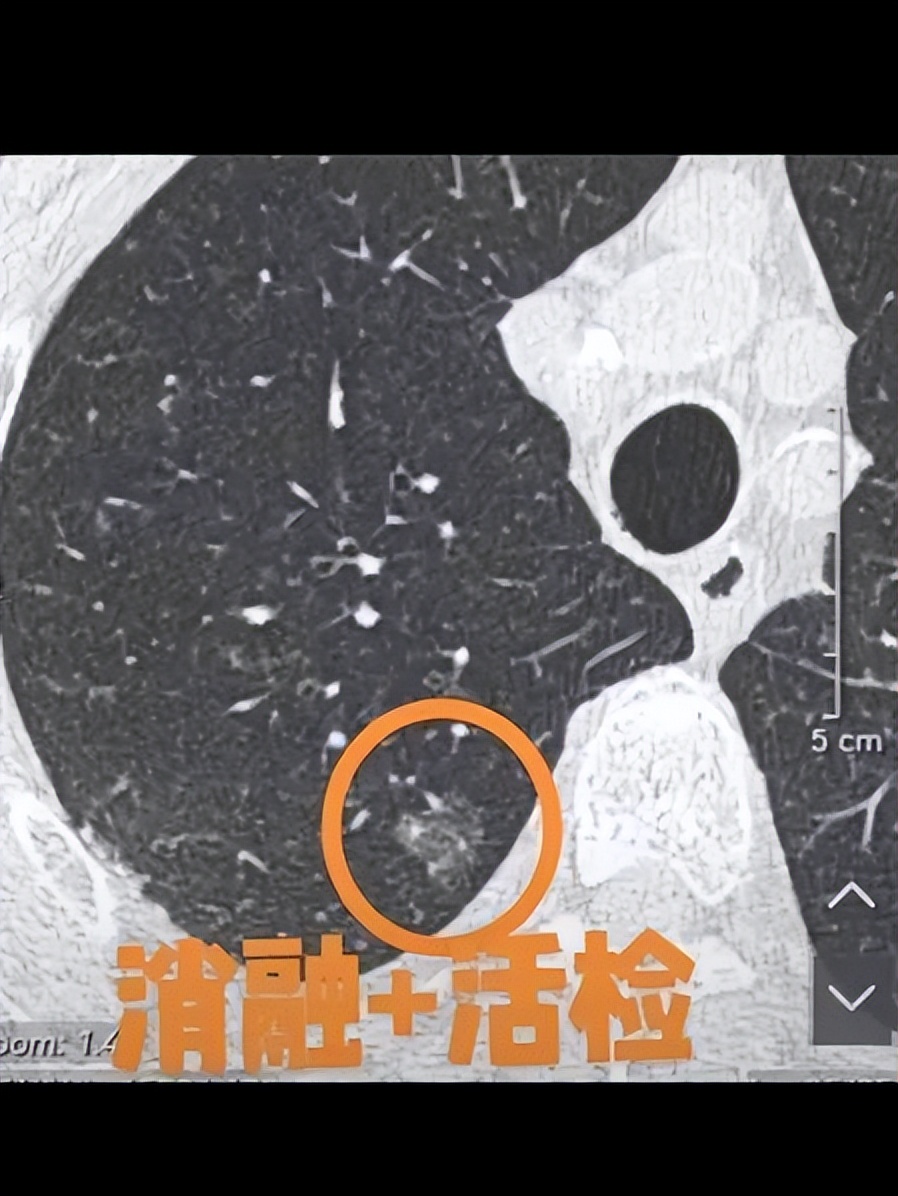 浙江首例！医生用钝头微波消融针为8旬老人“烫死”高危肺结节