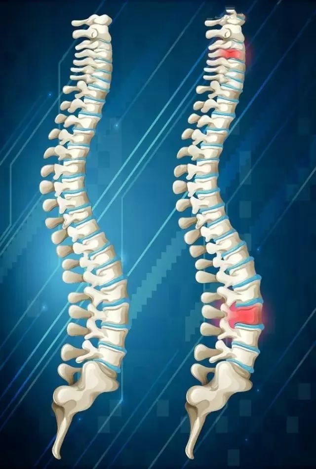 胸椎小关节紊乱和冠心病,胸椎小关节紊乱心脏