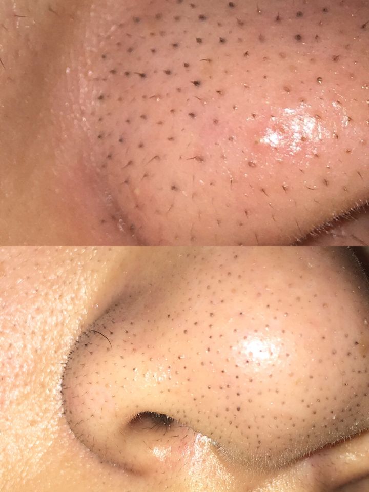 黑头是不是真的去不掉,黑头为什么根本去不掉