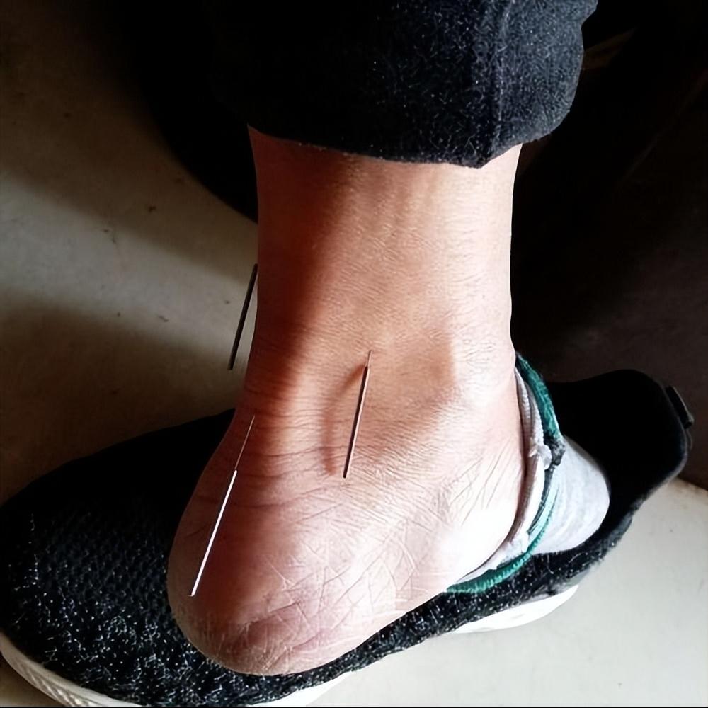 中医无痛治疗?芒针治疗中风后的寒热错杂型消化不良疗效相关研究