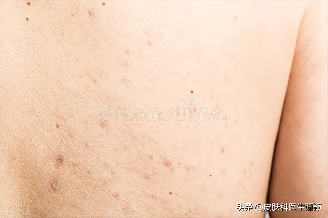 皮肤科医生后背长痘痘怎么办,胸和后背长痒痒的痘痘是怎么了