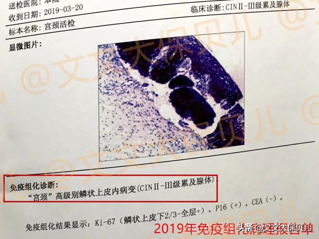 cin2-3累及腺体是宫颈癌吗,cin3级并累及腺体到宫颈癌多久