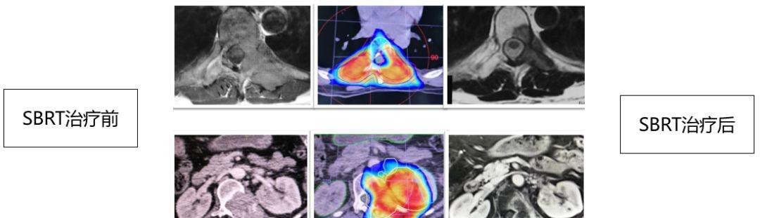 放疗联合免疫治疗肾癌,晚期癌症化疗加免疫治疗效果怎样