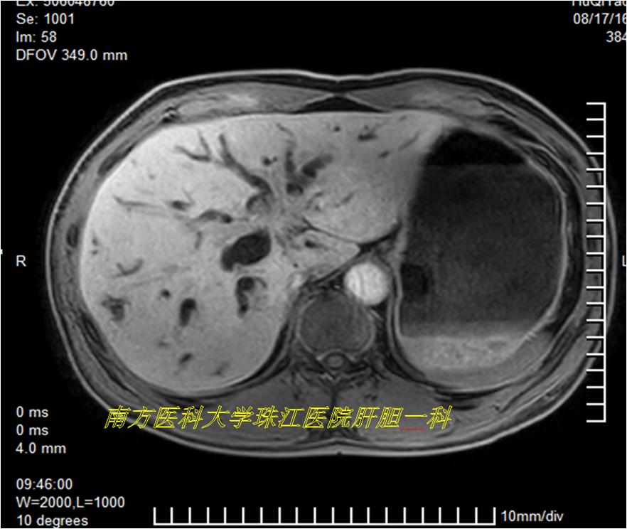 三维透视眼,透视眼治疗肿瘤