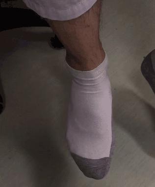 脚踝足内翻可以恢复吗,后天足内翻走路姿势