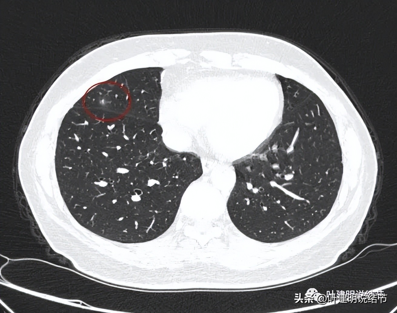辽宁省肺结节手术哪家医院好,辽宁肺结节手术医院
