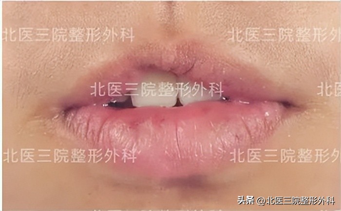 上嘴唇缺一块怎么修补,上嘴唇缺损