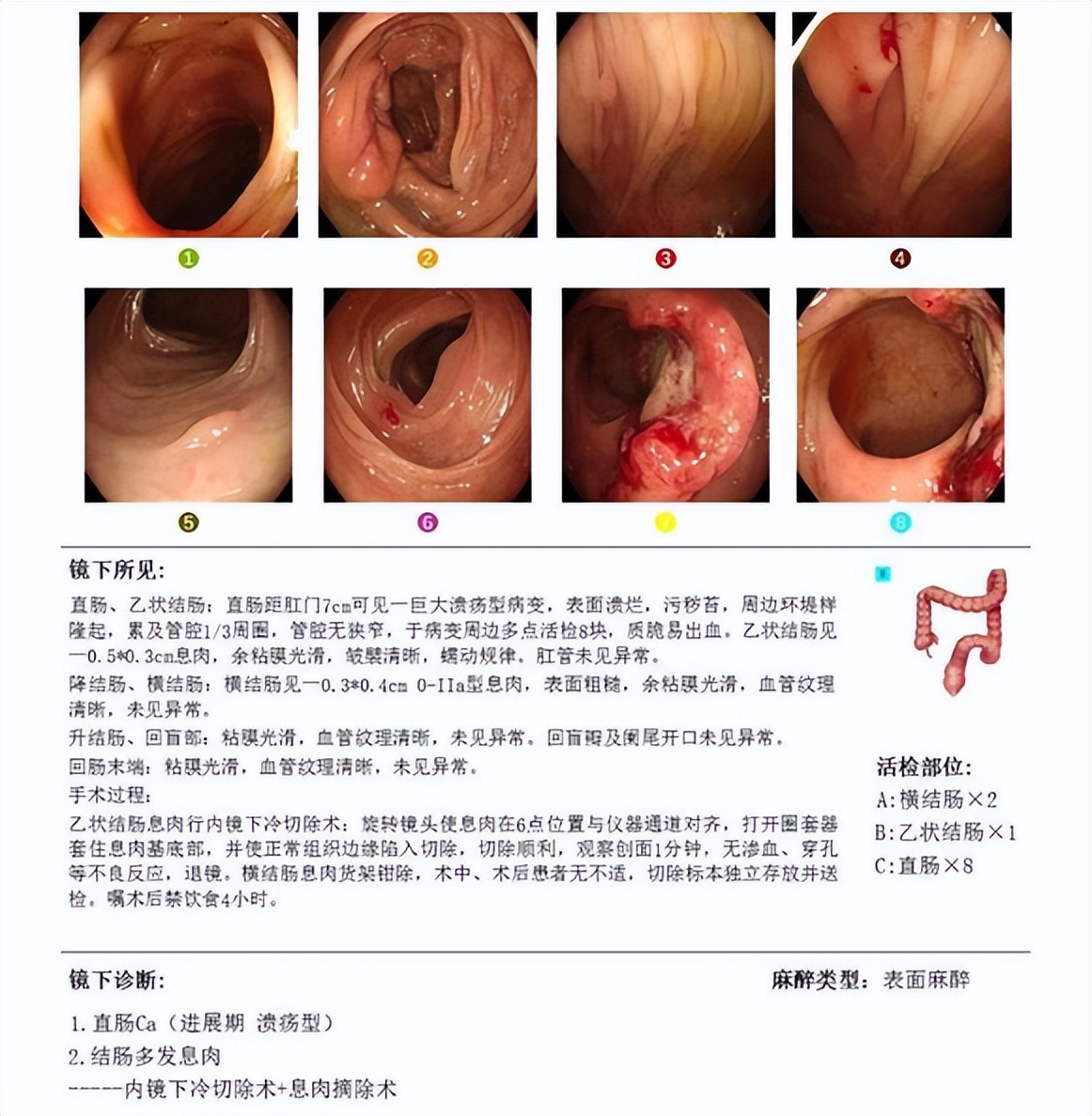 中国国内结直肠癌最新治疗,结直肠癌治好的可能性大吗