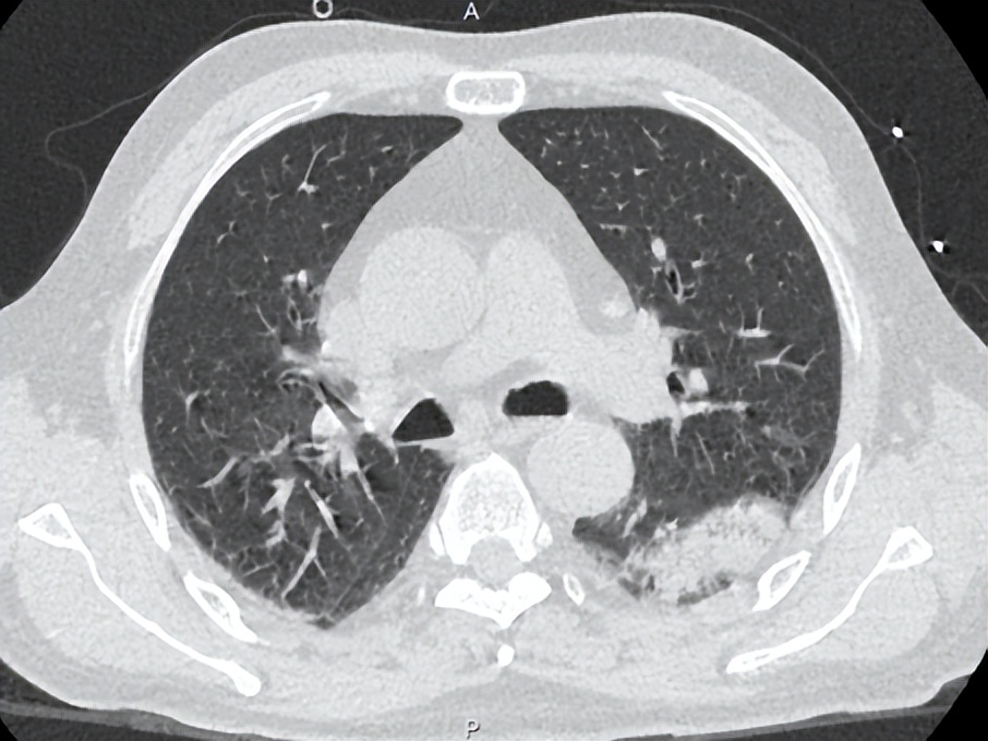 发热十多天了输液吃药还是发热,脓毒症高烧不退