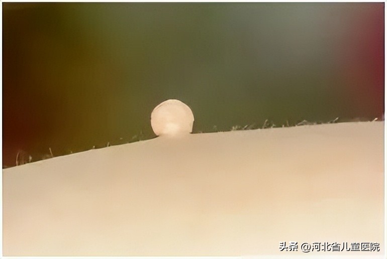 脖子上很多小肉揪图片,脖子长个肉揪揪怎么去除