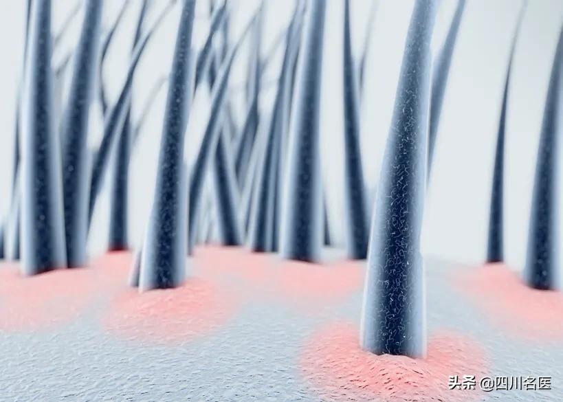 头屑多可能是脱发前兆,头屑越来越多是脱发的表现吗