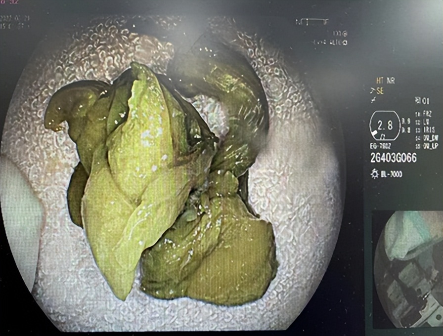 七旬大伯一吃就吐，发现胃里堵着一团酸菜！医生：“罪魁祸首”不是它