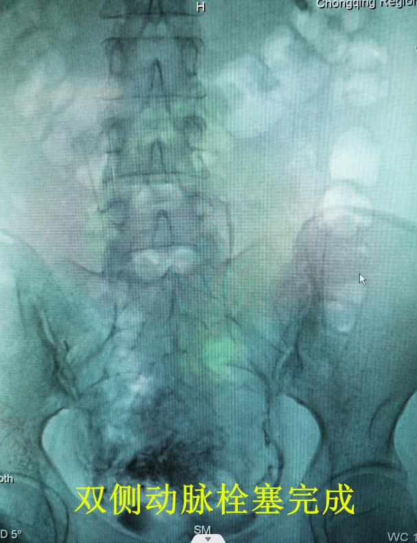 宫外孕大出血手术成功,腹腔镜下肝部分切除术大出血