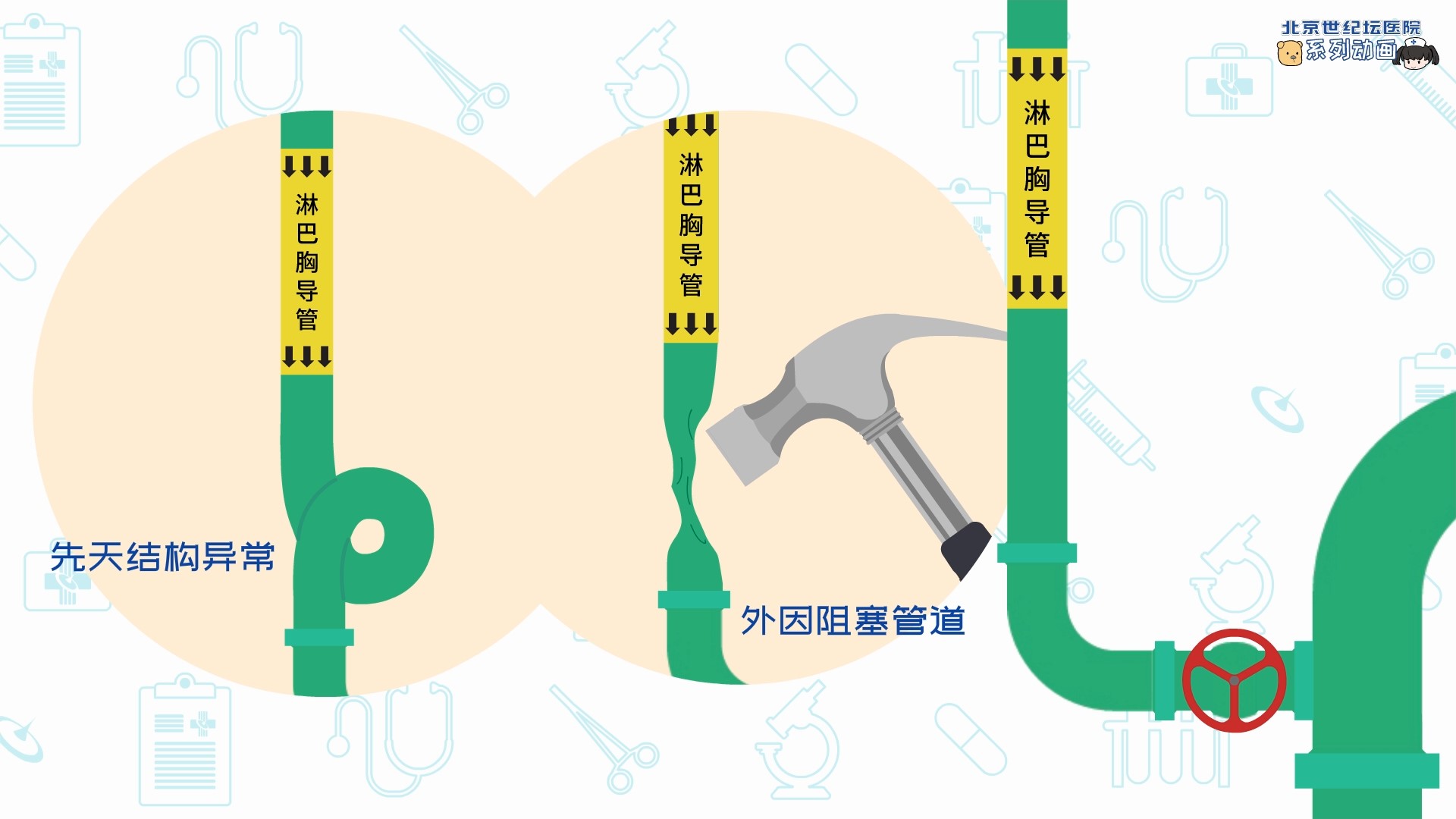 开胸探查术手术记录,胸导管微创手术全过程