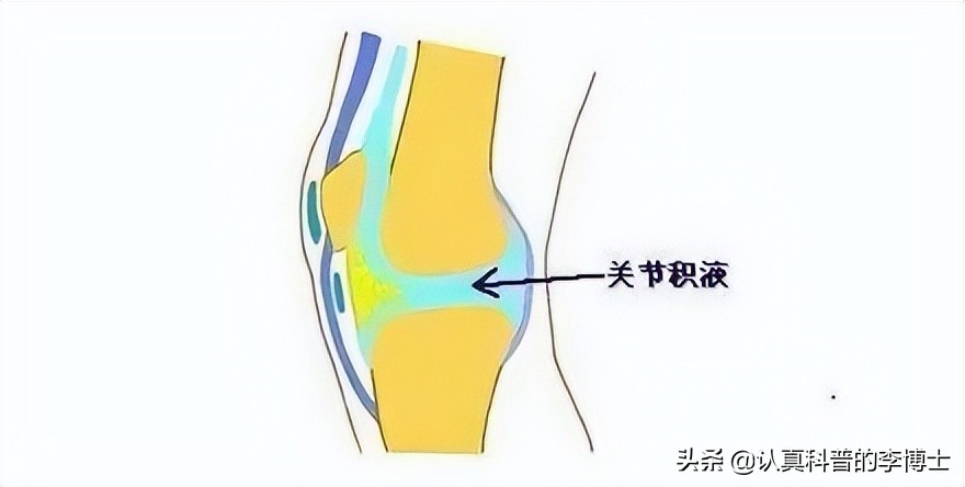 关节有积液需要抽吗,抽关节积液有什么危害